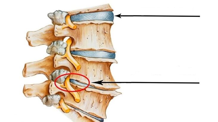 Wirbelsäulenverletzung bei zervikaler Osteochondrose