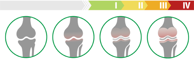 Klinische Stadien der Arthrose des Kniegelenks (Grad der Arthrose des Kniegelenks)