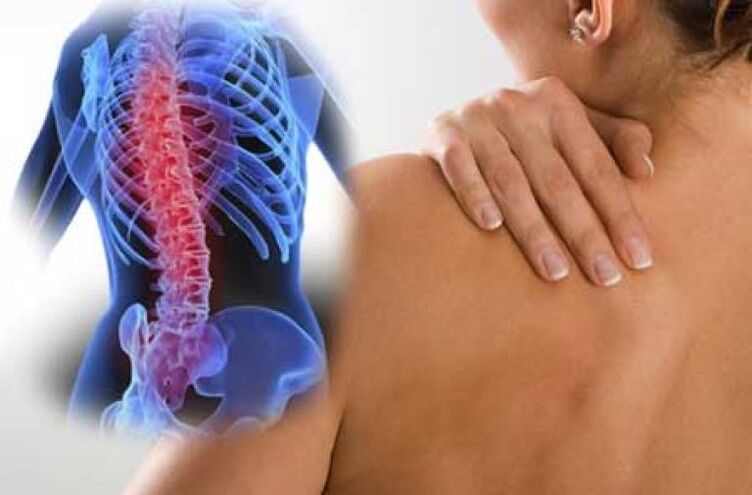 Bei einer Exazerbation der Osteochondrose der Brustwirbelsäule treten Schmerzen im Rücken auf. 