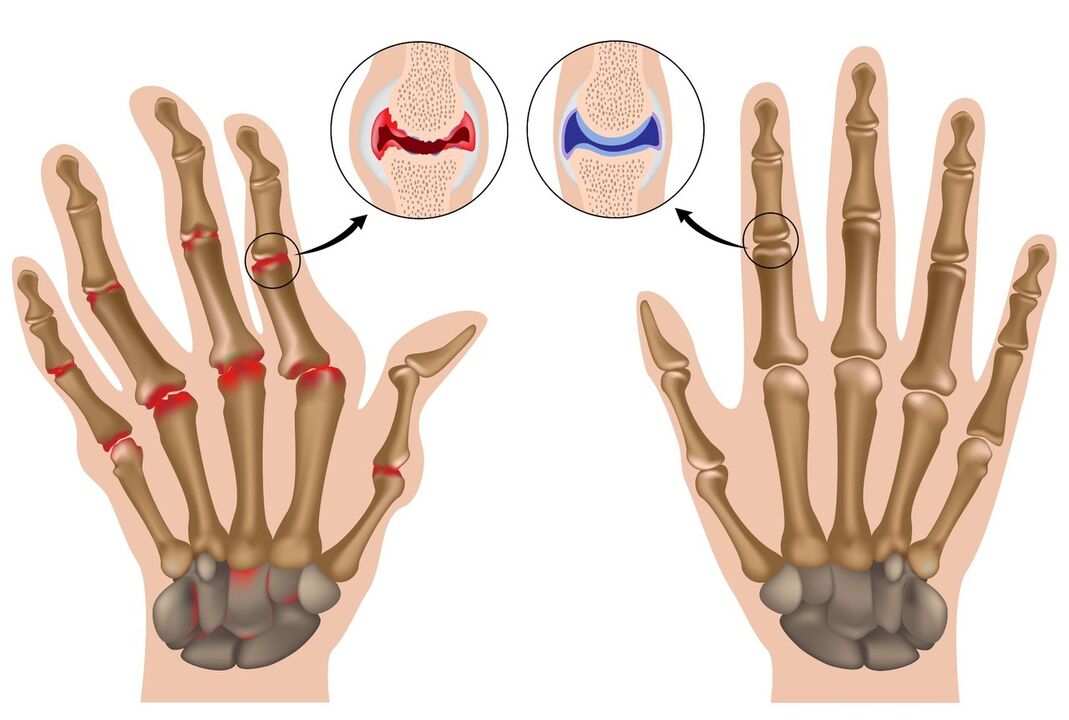 Gelenke gesunder und von Polyarthritis betroffener Hände