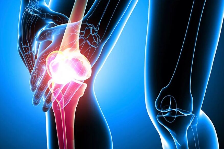 Knie -Arthrose