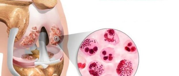 Dies führt zur Entwicklung einer Arthrose