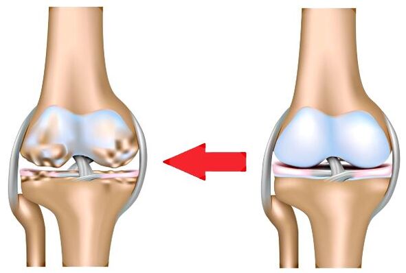Gesunde Artikulation und Arthrose