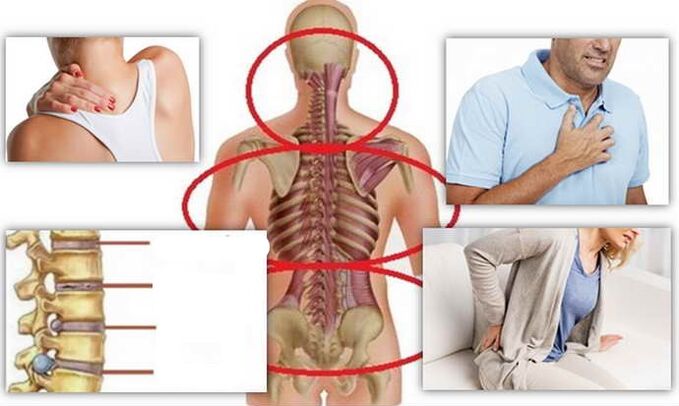 Krankheit Orte für Osteochondrose