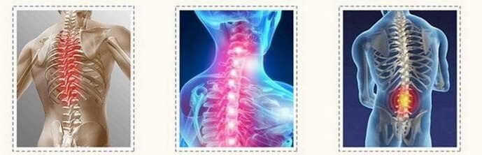 Spinalläsionen der Osteochondrose