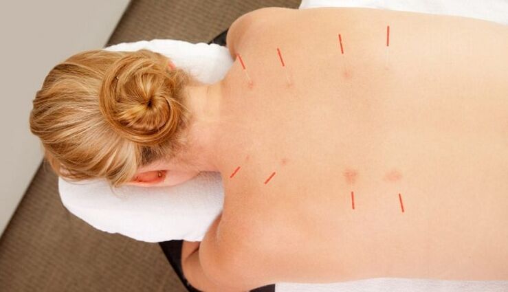 Akupunktur bei thorakaler Osteochondrose, die viele Vorteile hat.